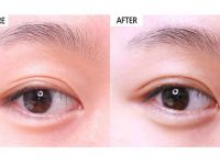 北京艾玛李方奇双眼皮修复口碑技术怎么样？李方奇双眼皮修复案例
