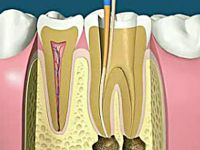 根管治疗就是抽牙神经吗？根管治疗和牙髓治疗是一回事吗？
