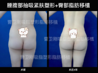 上海丰臀最好的医院和专家推荐：曹卫刚谢峰李旭东孙美庆邱文苑丰臀谁厉害？